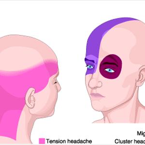 Cluster Headaches - Headache, Hypnosis And Stress, A Case History