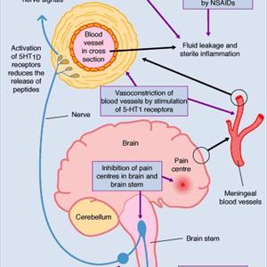 Heart Pfo Migraines - Treatment For Migraine Headaches