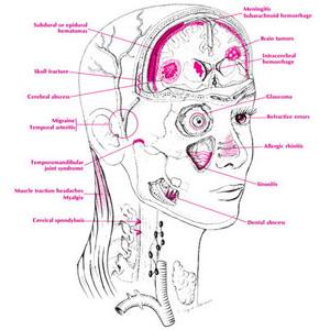 Confusional Migraine Symptoms - Menstrual Migraines