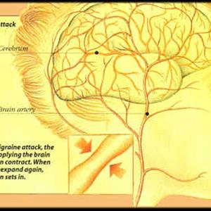 Persistent Migraine Tips - How To Treat Migraine Headaches