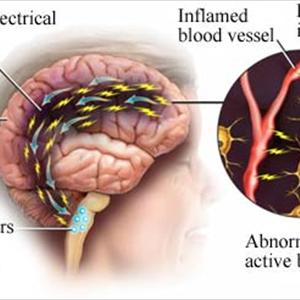 Migraine Headache Prevention - Does Chocolate Trigger Migraine?