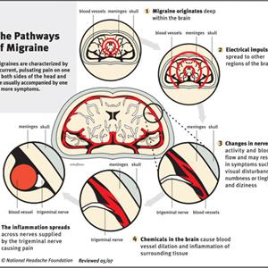 Migraine Statistics - Men Are More Likely To Suffer Cluster Migraines