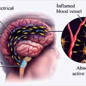 Migraine Prescription Doctor - Migraineheadachetreatments